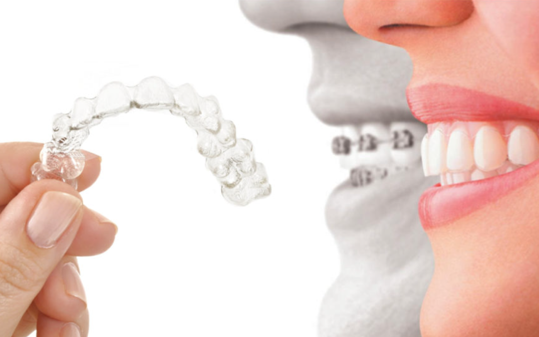 Invisalign: mascherine trasparenti per eccellenza